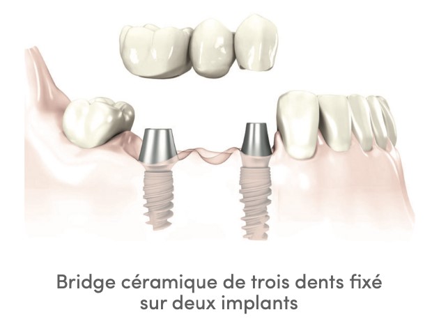 prothèse dentaire implant