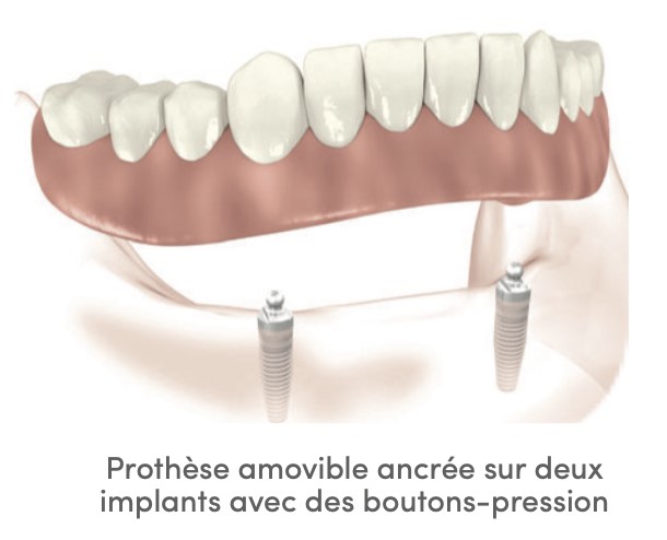 prothèse dentaire implant